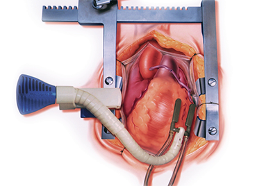 心拍動下冠動脈バイパス術に用いるスタビラーザーという道具により冠動脈予定吻合部は動かなくなる