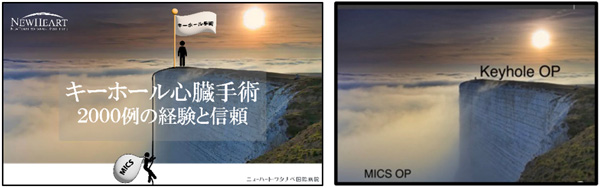キーホール手術へのこだわり