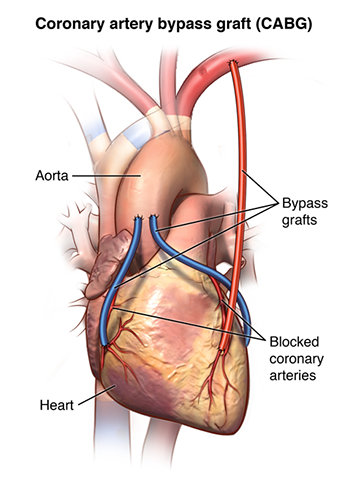 冠動脈バイパス術（CABG）｜渡邊剛 公式サイト