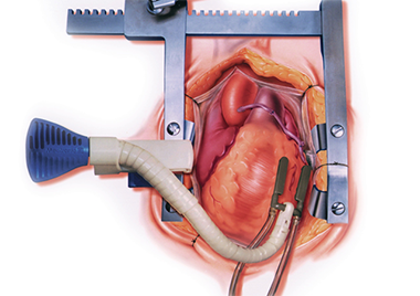 冠動脈バイパス術（CABG）｜渡邊剛 公式サイト