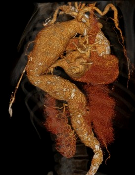 下行大動脈瘤の3DCT画像