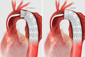 	遠位弓部大動脈瘤および下行大動脈瘤へのステントグラフト